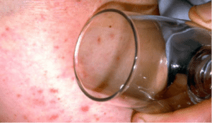 Meningitis Glass test