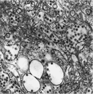 Tick Bourne Encephalitis