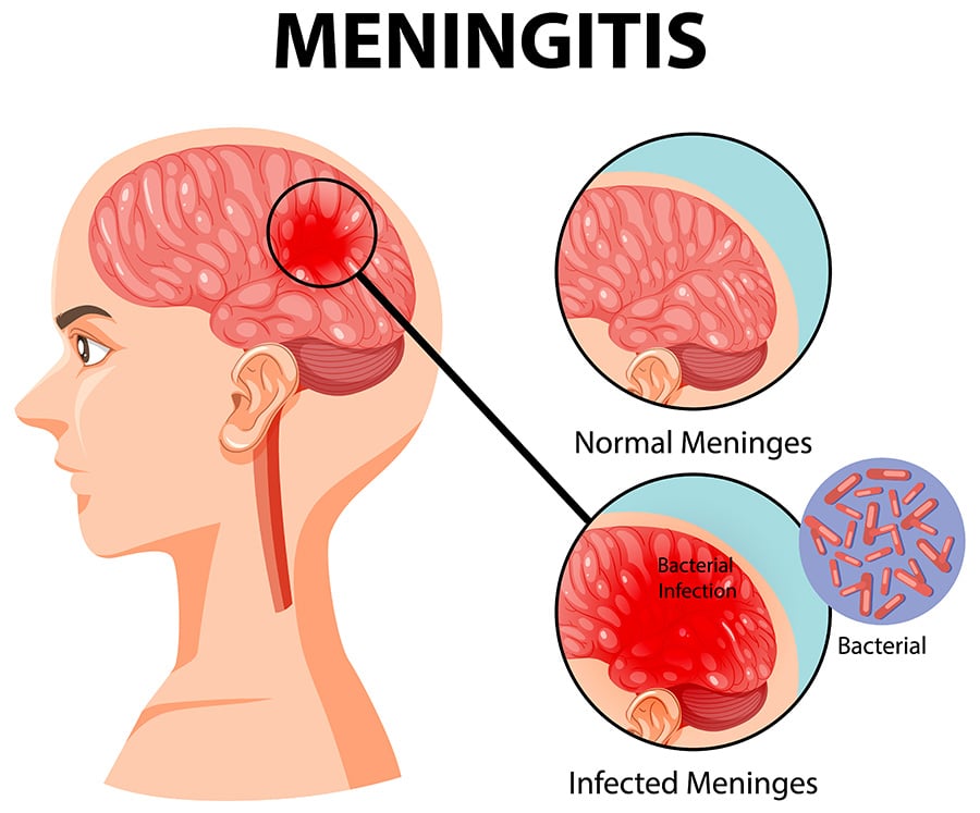 Image showing how Meningitis affects the brain